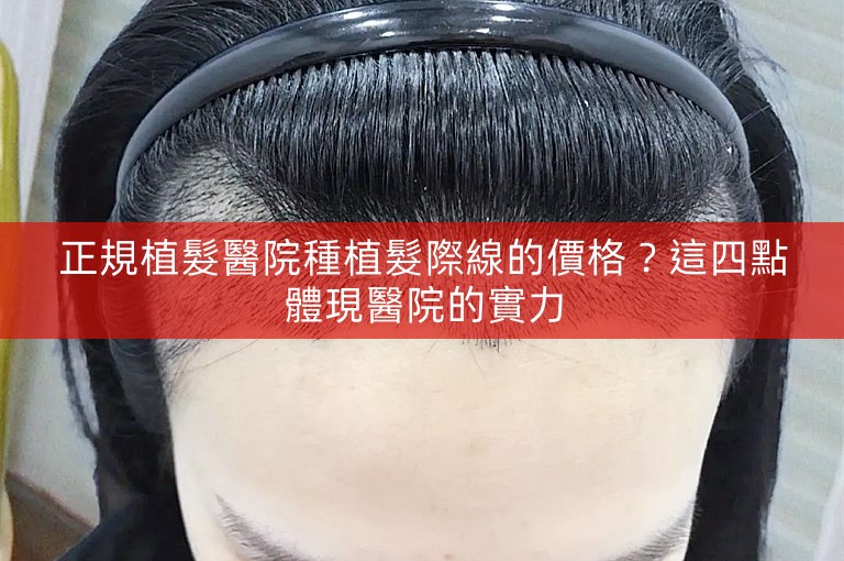 正規植髮醫院種植髮際線的價格？這四點體現醫院的實力