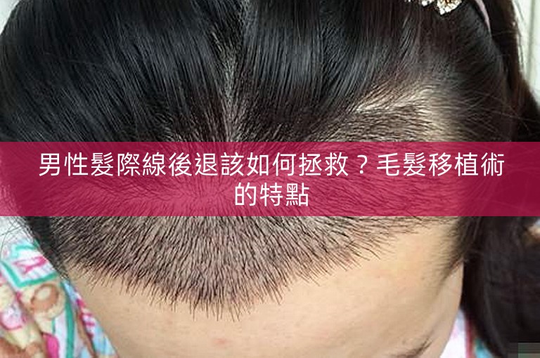 男性髮際線後退該如何拯救？毛髮移植術的特點