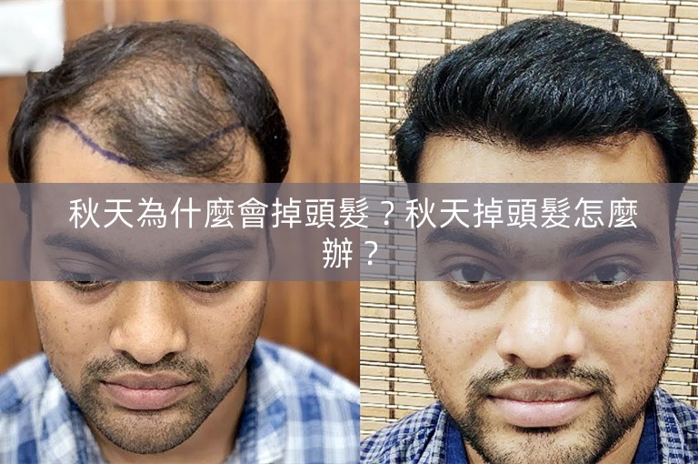  秋天為什麼會掉頭髮？秋天掉頭髮怎麼辦？