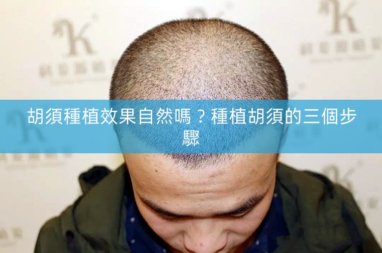 胡須種植效果自然嗎?種植胡須的三個步驟 胡須種植效果自然嗎?種植胡須的三個步驟