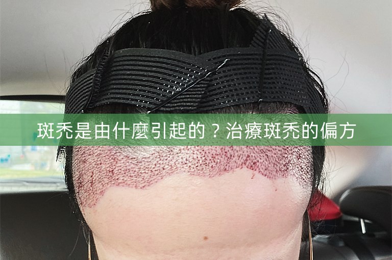 斑禿是由什麼引起的？治療斑禿的偏方