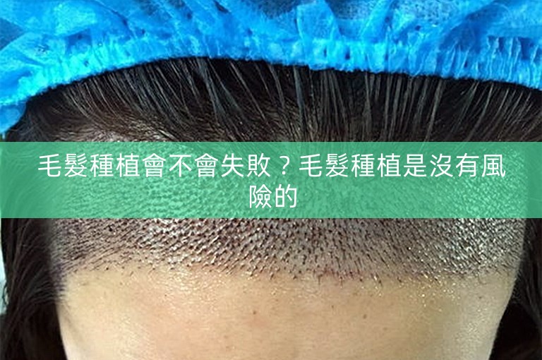 毛髮種植會不會失敗？毛髮種植是沒有風險的