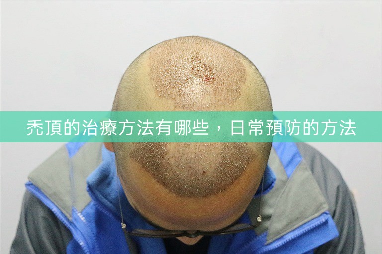 禿頂的治療方法有哪些,日常預防的方法 禿頂的治療方法有哪些,日常預防的方法