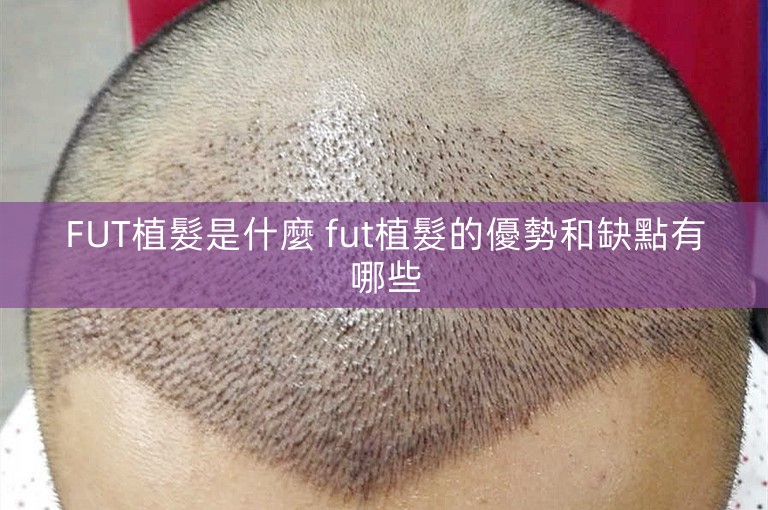 FUT植髮是什麼 fut植髮的優勢和缺點有哪些