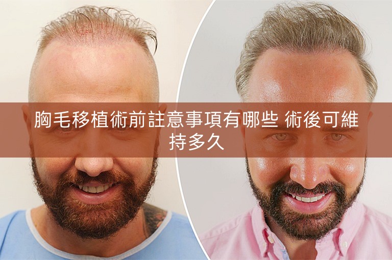 胸毛移植術前註意事項有哪些 術後可維持多久 胸毛移植術前註意事項有哪些 術後可維持多久