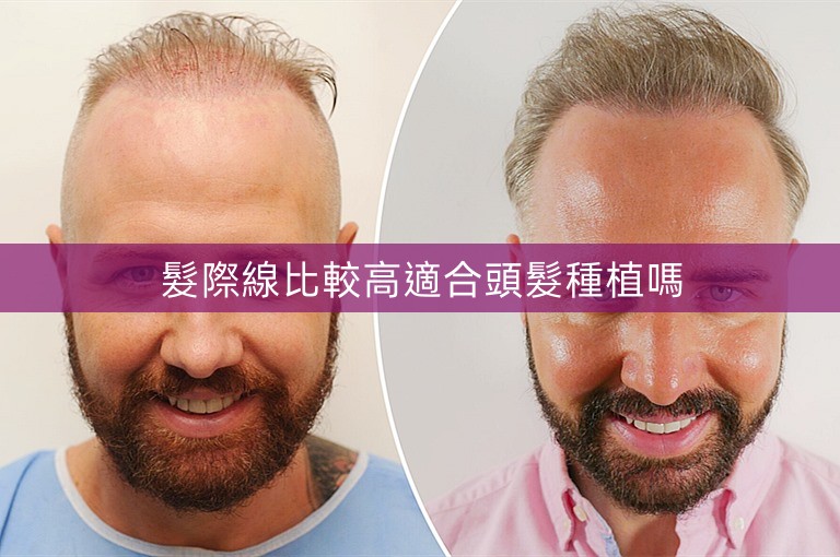 髮際線比較高適合頭髮種植嗎