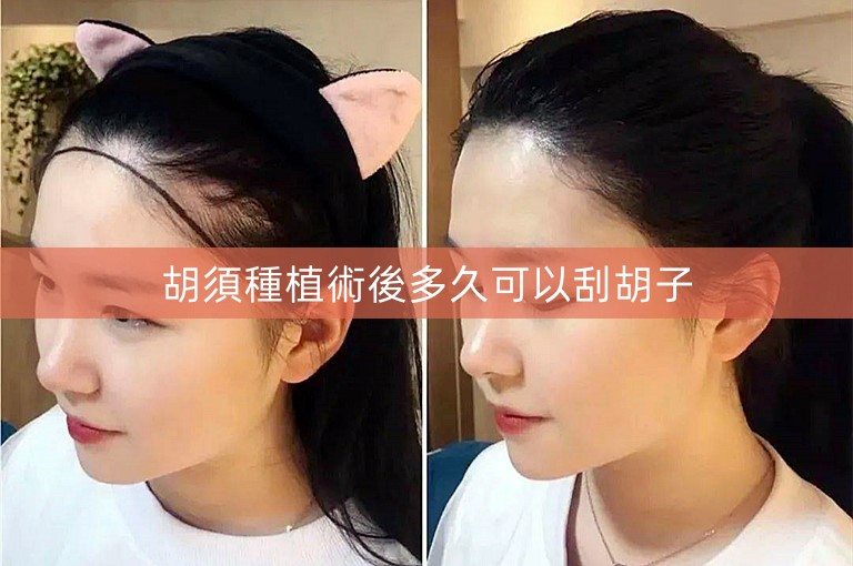 胡須種植術後多久可以刮胡子