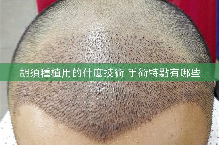 胡須種植用的什麼技術 手術特點有哪些