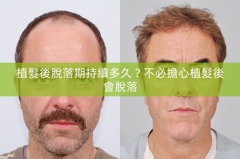 植髮後脫落期持續多久？不必擔心植髮後會脫落