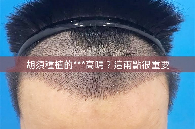 胡須種植的***高嗎？這兩點很重要