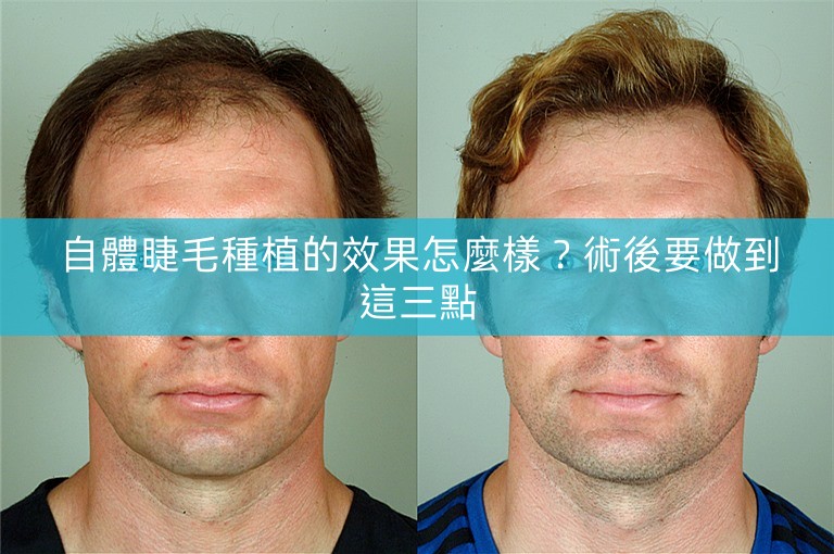 自體睫毛種植的效果怎麼樣？術後要做到這三點