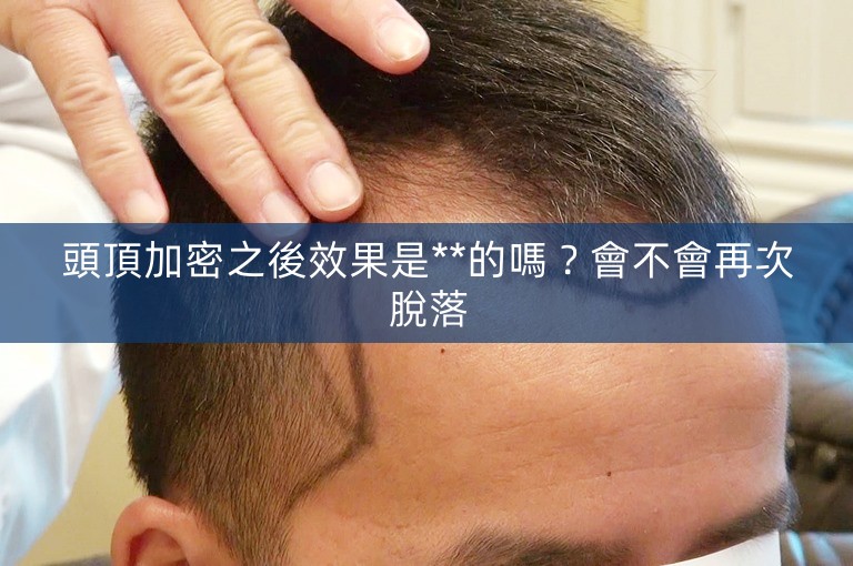 頭頂加密之後效果是**的嗎？會不會再次脫落