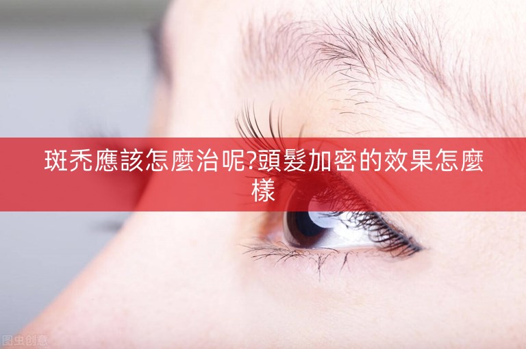 斑禿應該怎麼治呢?頭髮加密的效果怎麼樣