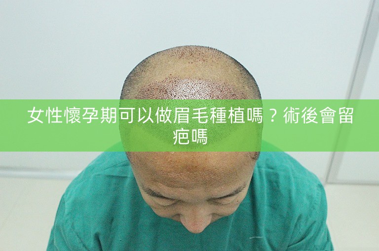 女性懷孕期可以做眉毛種植嗎？術後會留疤嗎