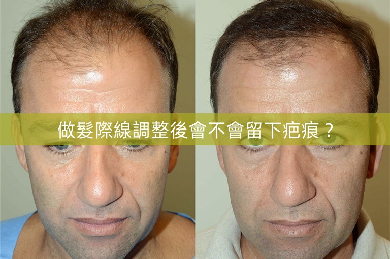 做髮際線調整後會不會留下疤痕？