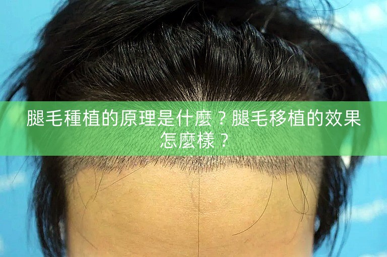 腿毛種植的原理是什麼?腿毛移植的效果怎麼樣? 腿毛種植的原理是什麼?腿毛移植的效果怎麼樣?