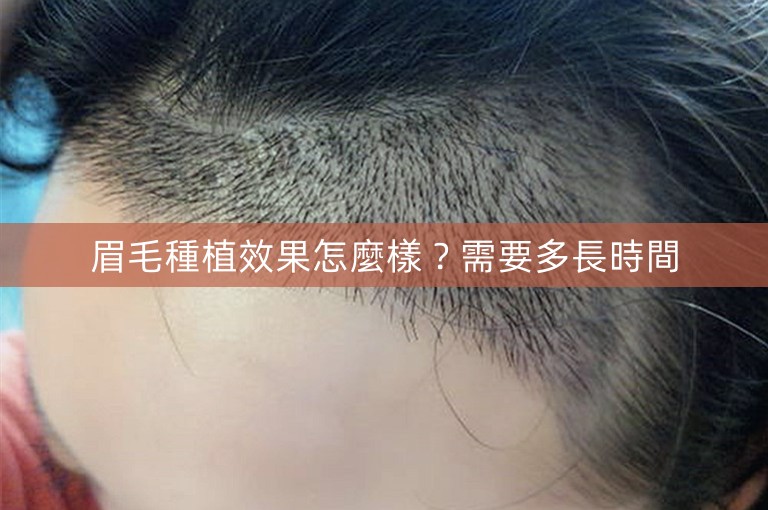 眉毛種植效果怎麼樣？需要多長時間