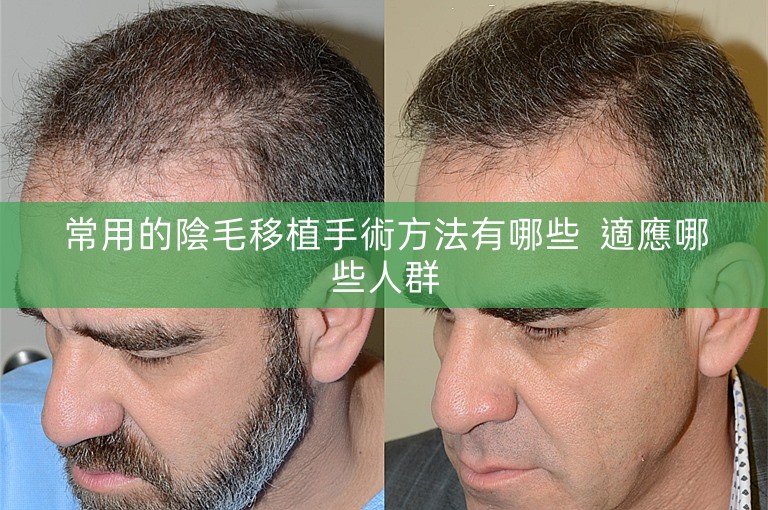 常用的陰毛移植手術方法有哪些 適應哪些人群 常用的陰毛移植手術方法有哪些 適應哪些人群
