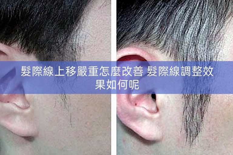 髮際線上移嚴重怎麼改善 髮際線調整效果如何呢