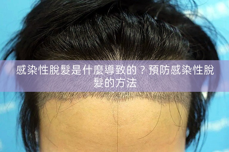 感染性脫髮是什麼導致的?預防感染性脫髮的方法 感染性脫髮是什麼導致的?預防感染性脫髮的方法