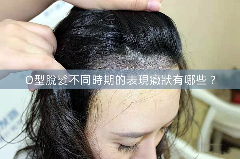 O型脫髮不同時期的表現癥狀有哪些？