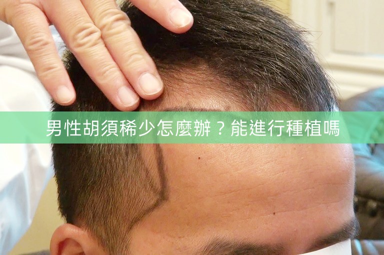 男性胡須稀少怎麼辦?能進行種植嗎 男性胡須稀少怎麼辦?能進行種植嗎
