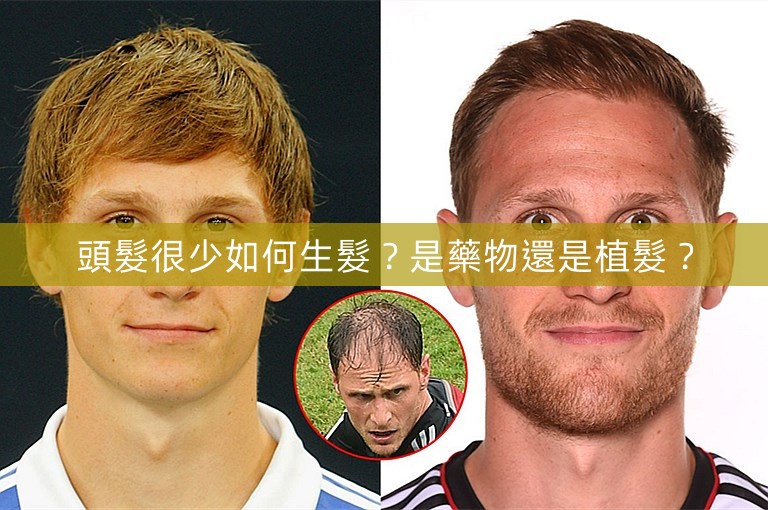 頭髮很少如何生髮?是藥物還是植髮? 頭髮很少如何生髮?是藥物還是植髮?