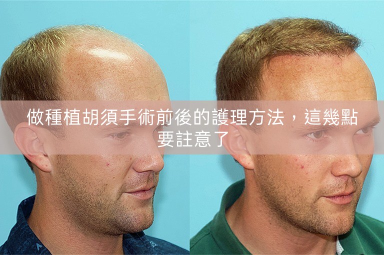 做種植胡須手術前後的護理方法,這幾點要註意了 做種植胡須手術前後的護理方法,這幾點要註意了