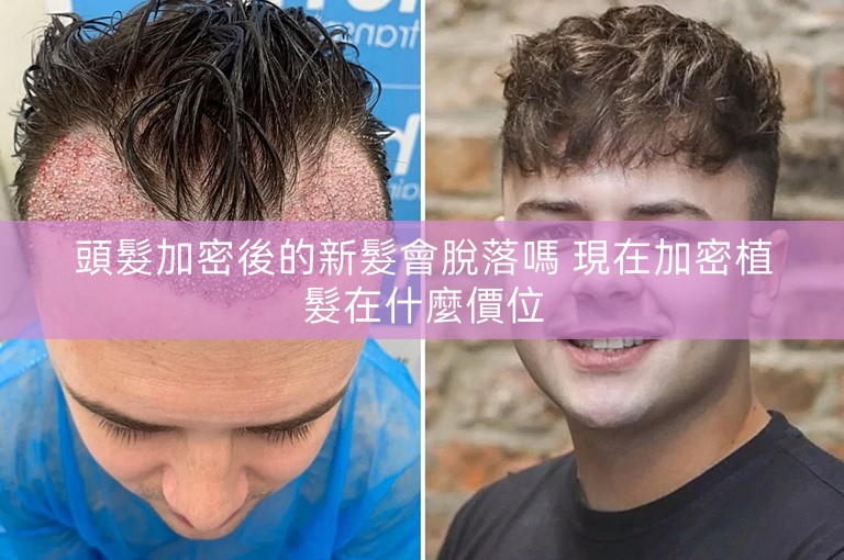頭髮加密後的新髮會脫落嗎 現在加密植髮在什麼價位