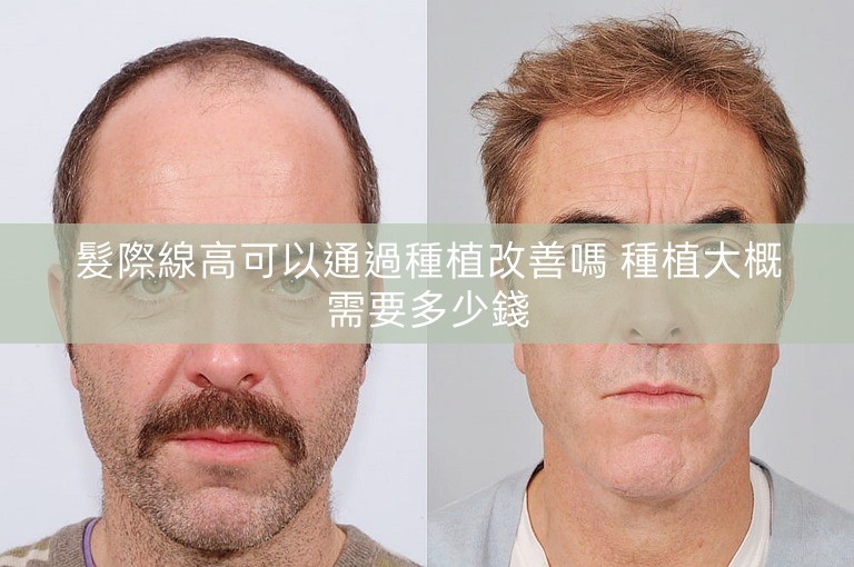 髮際線高可以通過種植改善嗎 種植大概需要多少錢