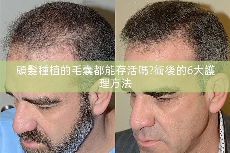 頭髮種植的毛囊都能存活嗎?術後的6大護理方法