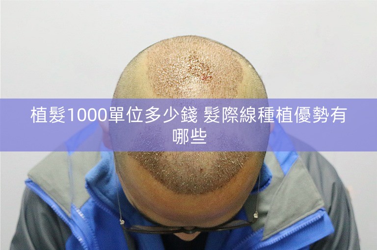 植髮1000單位多少錢 髮際線種植優勢有哪些