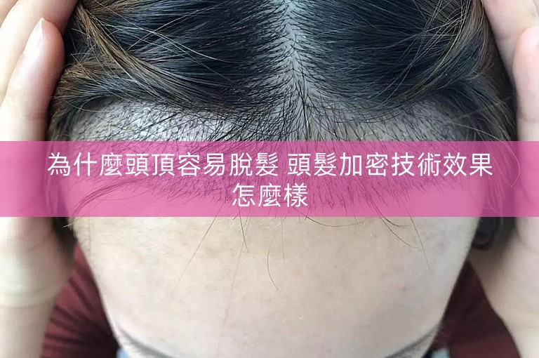 為什麼頭頂容易脫髮 頭髮加密技術效果怎麼樣
