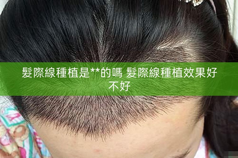 髮際線種植是**的嗎 髮際線種植效果好不好