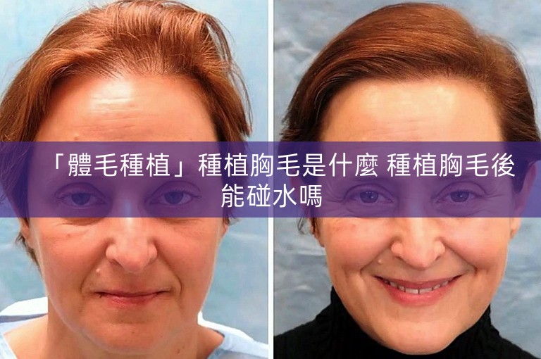 「體毛種植」種植胸毛是什麼 種植胸毛後能碰水嗎 「體毛種植」種植胸毛是什麼 種植胸毛後能碰水嗎