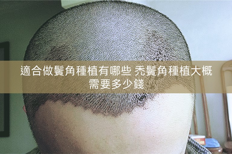 適合做鬢角種植有哪些 禿鬢角種植大概需要多少錢