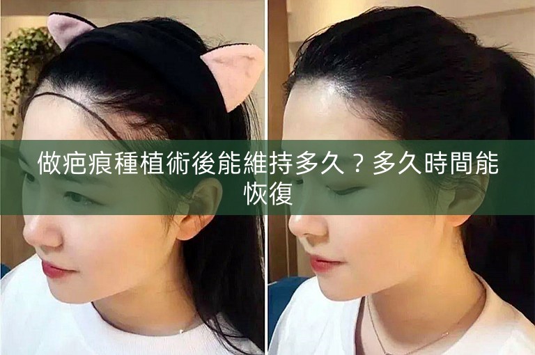 做疤痕種植術後能維持多久？多久時間能恢復