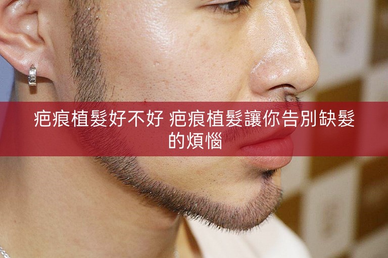 疤痕植髮好不好 疤痕植髮讓你告別缺髮的煩惱