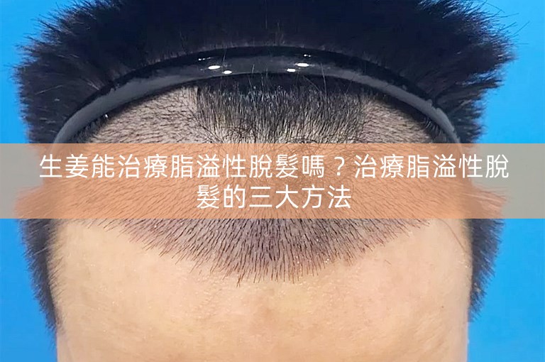 生姜能治療脂溢性脫髮嗎？治療脂溢性脫髮的三大方法