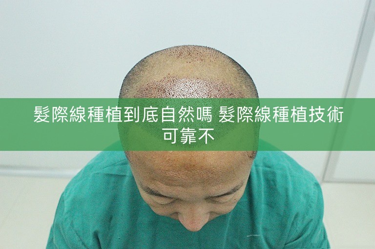 髮際線種植到底自然嗎 髮際線種植技術可靠不