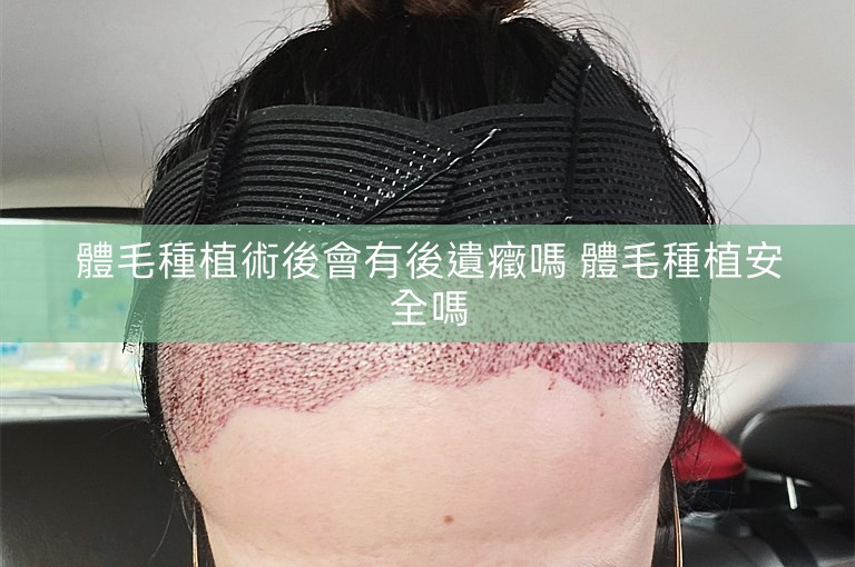 體毛種植術後會有後遺癥嗎 體毛種植安全嗎 體毛種植術後會有後遺癥嗎 體毛種植安全嗎