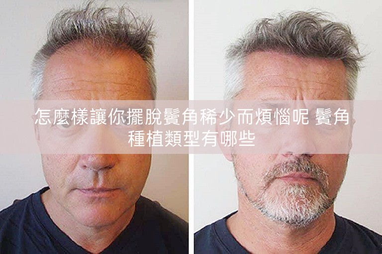 怎麼樣讓你擺脫鬢角稀少而煩惱呢 鬢角種植類型有哪些