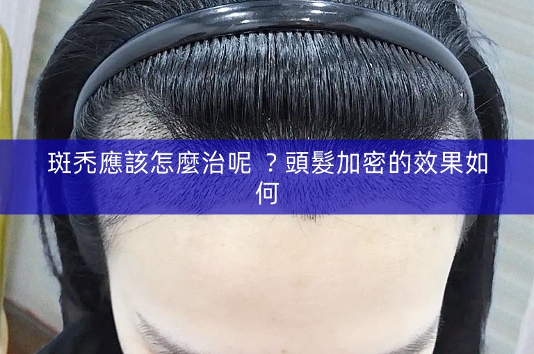 斑禿應該怎麼治呢 ？頭髮加密的效果如何