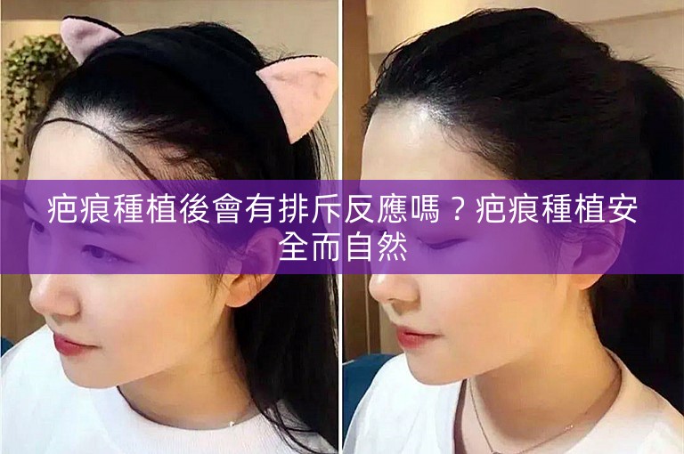 疤痕種植後會有排斥反應嗎？疤痕種植安全而自然