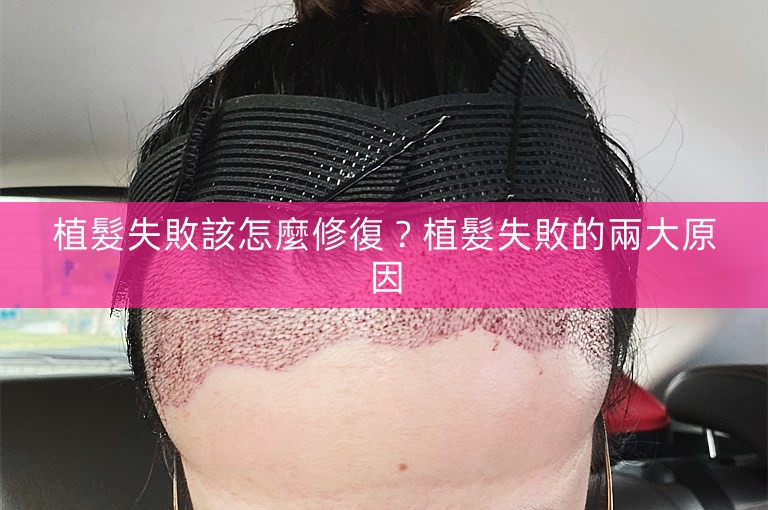 植髮失敗該怎麼修復?植髮失敗的兩大原因 植髮失敗該怎麼修復?植髮失敗的兩大原因