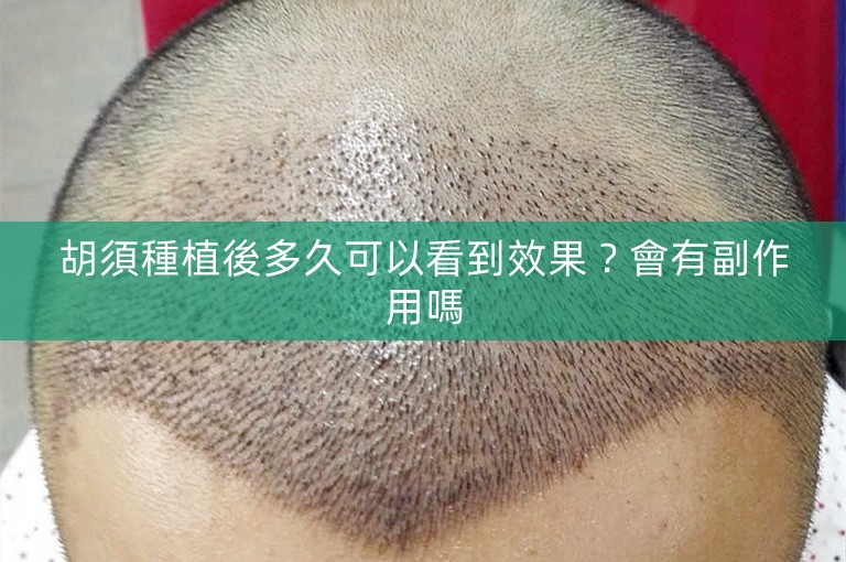 胡須種植後多久可以看到效果？會有副作用嗎