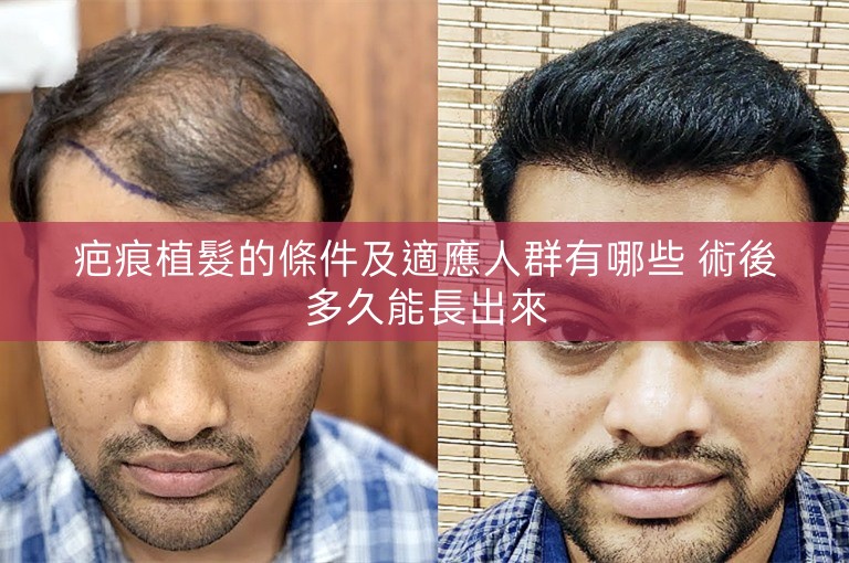 疤痕植髮的條件及適應人群有哪些 術後多久能長出來