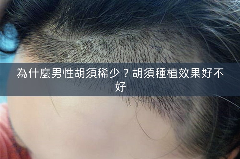 為什麼男性胡須稀少?胡須種植效果好不好 為什麼男性胡須稀少?胡須種植效果好不好