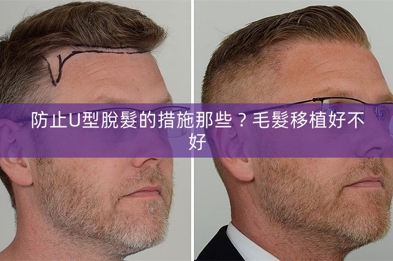 防止U型脫髮的措施那些？毛髮移植好不好