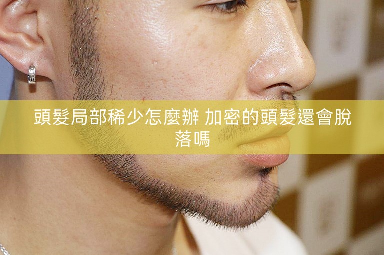 頭髮局部稀少怎麼辦 加密的頭髮還會脫落嗎